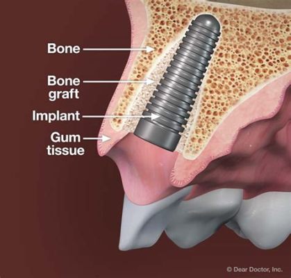 Vitroceramic: The Revolutionary Material Transforming Dental Implants and Bone Tissue Engineering?